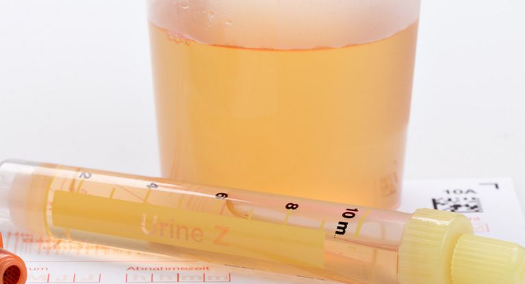 Urinprobe in kleinen Plastikgefäßen