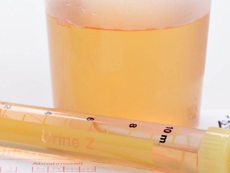 Urinprobe in kleinen Plastikgefäßen